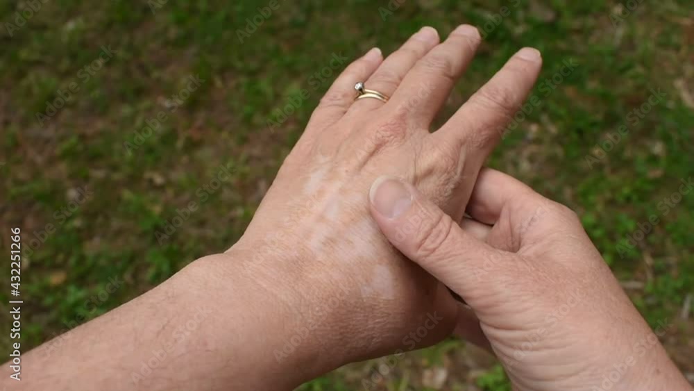 Vitiligo hands autoimmune disease Vitiligo hands autoimmune disease