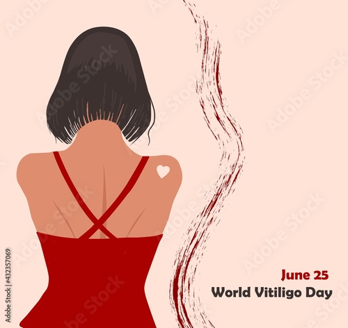 June 25 - World Vitiligo Day. Pigmentation disorders. Skin depigmentation. Vector illustration on the theme of rare diseases. Chronic skin disease