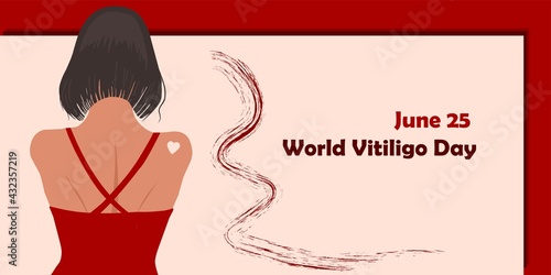 June 25 - World Vitiligo Day. Pigmentation disorders. Skin depigmentation. Vector illustration on the theme of rare diseases. Chronic skin disease