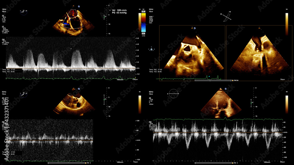 transesophageal and transthoracic ultrasound images of the human heart ...