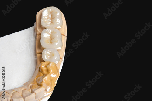 ceramic dental bridge for molars and premolars. on a black background. copy space