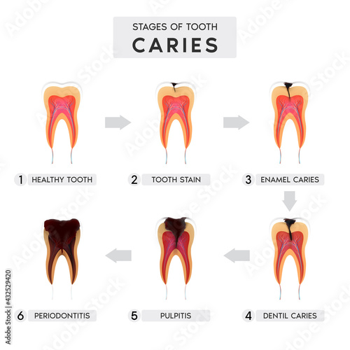Tooth caries structure and Progression and Treatment: Dental Illustration. In realistic style. Stain, enamel caries, dentil, pulpitis, periodontitis. Vector illustration 3d.