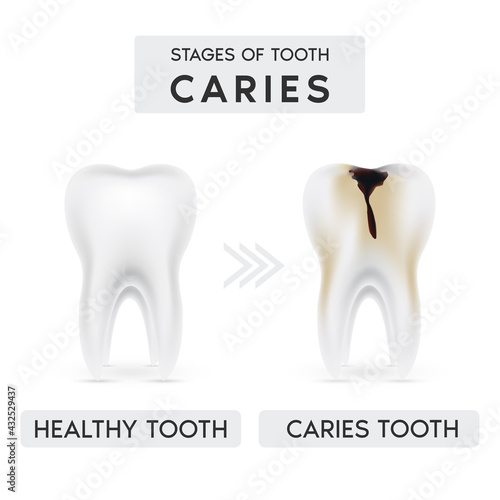 Tooth caries structure and Progression and Treatment: Dental Illustration. In realistic style. Stain, enamel caries, dentil, pulpitis, periodontitis. Vector illustration 3d.