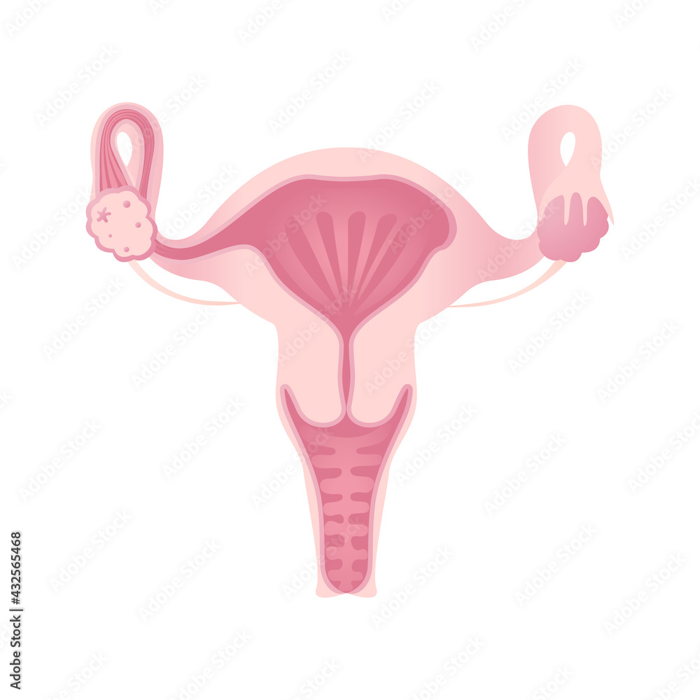 Anatomy of the female reproductive system. The layout of the female reproductive organs: uterus, cervix, ovary, fallopian tube. Anatomy of the female reproductive system. The layout of the female reproductive organs: uterus, cervix, ovary, fallopian tube.