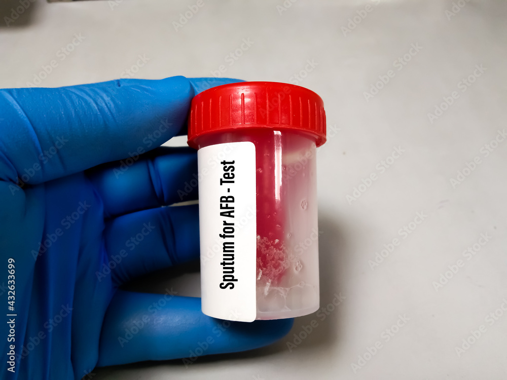Sputum sample container holding by doctor for AFB test. A Microscopic test for detecting