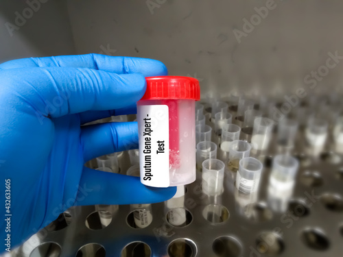 Sputum sample container holding by doctor for Genexpert test. A molecular test for detecting TB bacteria.