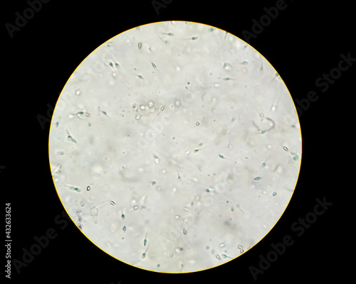 Semen analysis, sperm analysis on microscopic examination. Micrograph of Oligospermia photo