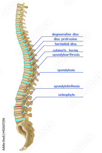 Damaged spine. Infographics of various back diseases. Vector illustration photo