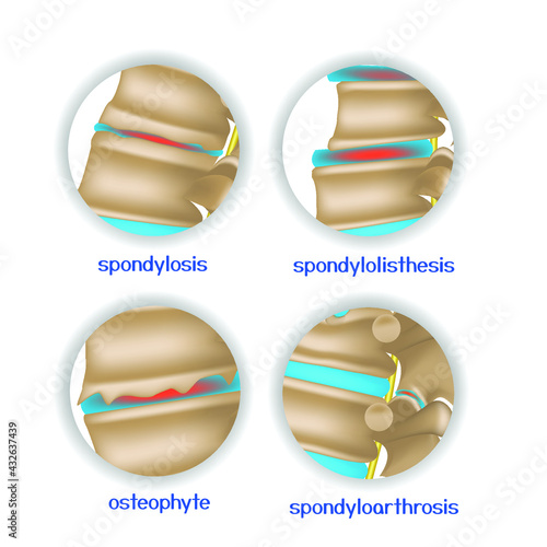 Spine diseases. Various pathologies of intervertebral discs and bones. 4 round icons. Vector illustration.