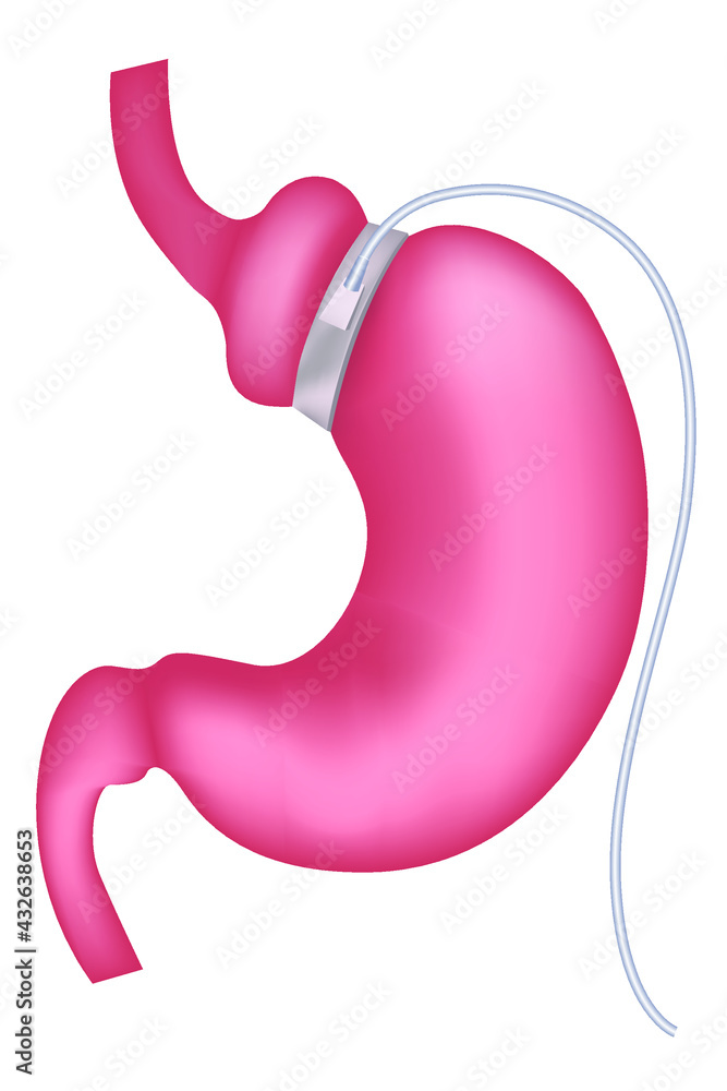 gastric banding. Slimming cuffs. Vector illustration. gastric banding. Slimming cuffs. Vector illustration.