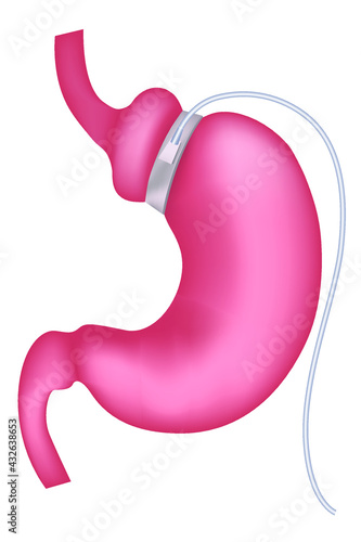 gastric banding. Slimming cuffs. Vector illustration.
