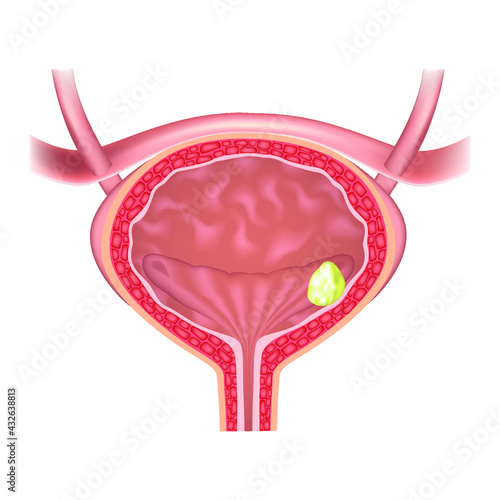 human bladder. Urolithiasis disease. Vector illustration.