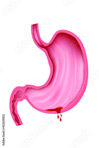 ulcer with perforation. Perforation of the stomach. Vector illustration.