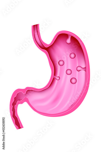 polyp of the stomach. Pathology of the digestive system. Vector illustration.