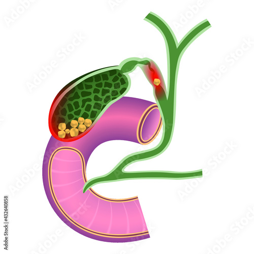 Gallbladder cancer. The excretory duct of the pancreas. Duodenum. Vector illustration.