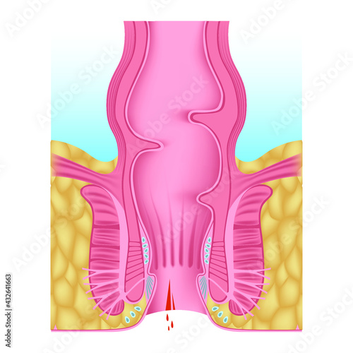 anal fissure. Hemorrhoids of the anal opening. Digestive system anatomy. Medical chart. Hemorrhoidal plexus. Vector illustration