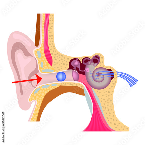 Foreign body in the inner ear. The structure of the human auditory system. Medical poster. Vector illustration