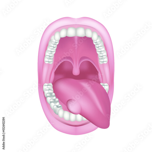 Swelling in the tongue. Wide open mouth. Upper and lower jaw with teeth. Disease of the oral cavity. Medical illustration.