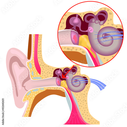 Inner ear anatomy. Damage to the tympanic membrane. Accumulation of pus. Medical illustration.
