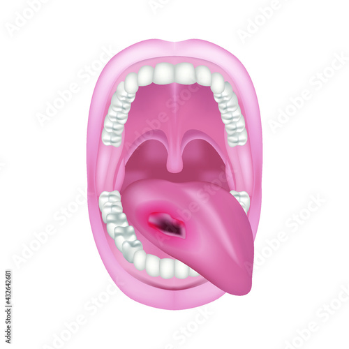 cancer of the tongue, oral cavity. The wound is in the mouth. Oncology. Jaw anatomy. Vector illustration