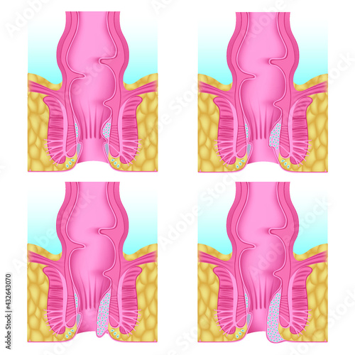 stages of development of hemorrhoids. Gradual proliferation of hemorrhoidal plexuses. Anatomy of the human anus. Vector illustration.