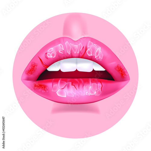 Chronic cheilitis. Dry chapped lips. Ripped skin. Disease of the mouth. Flaking skin flakes. Vector illustration photo