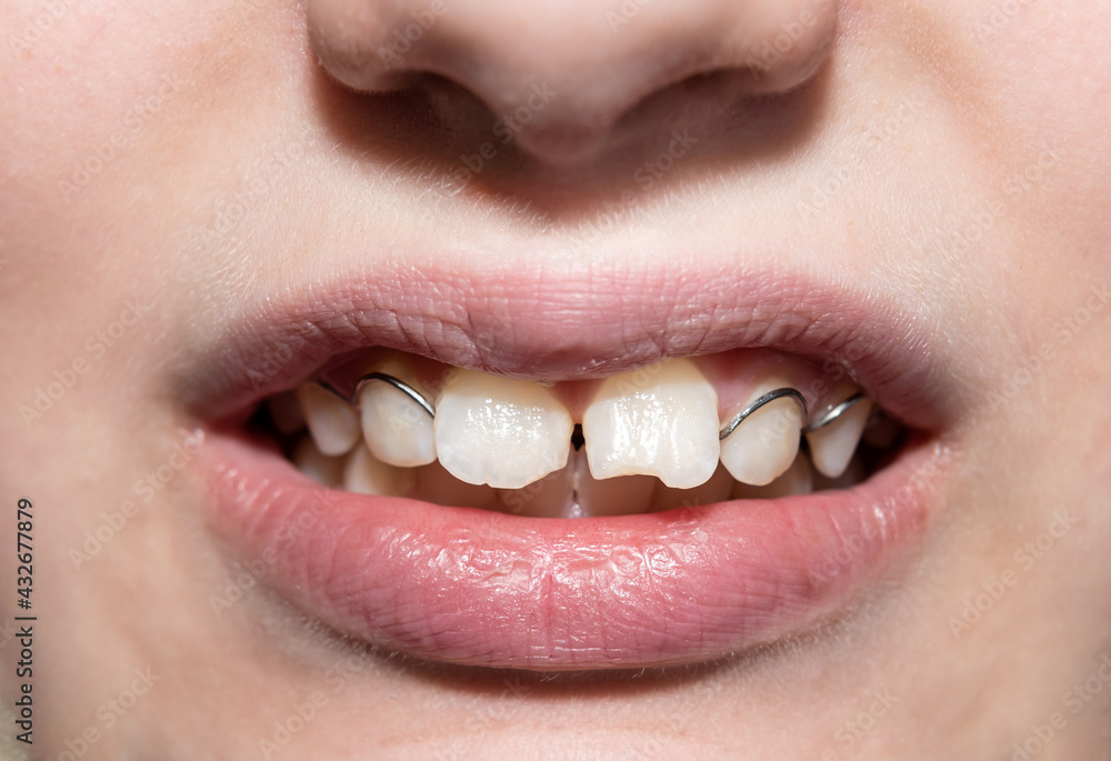 Naklejka premium Baby's teeth. Teeth. Teeth alignment plate. Dental Plate