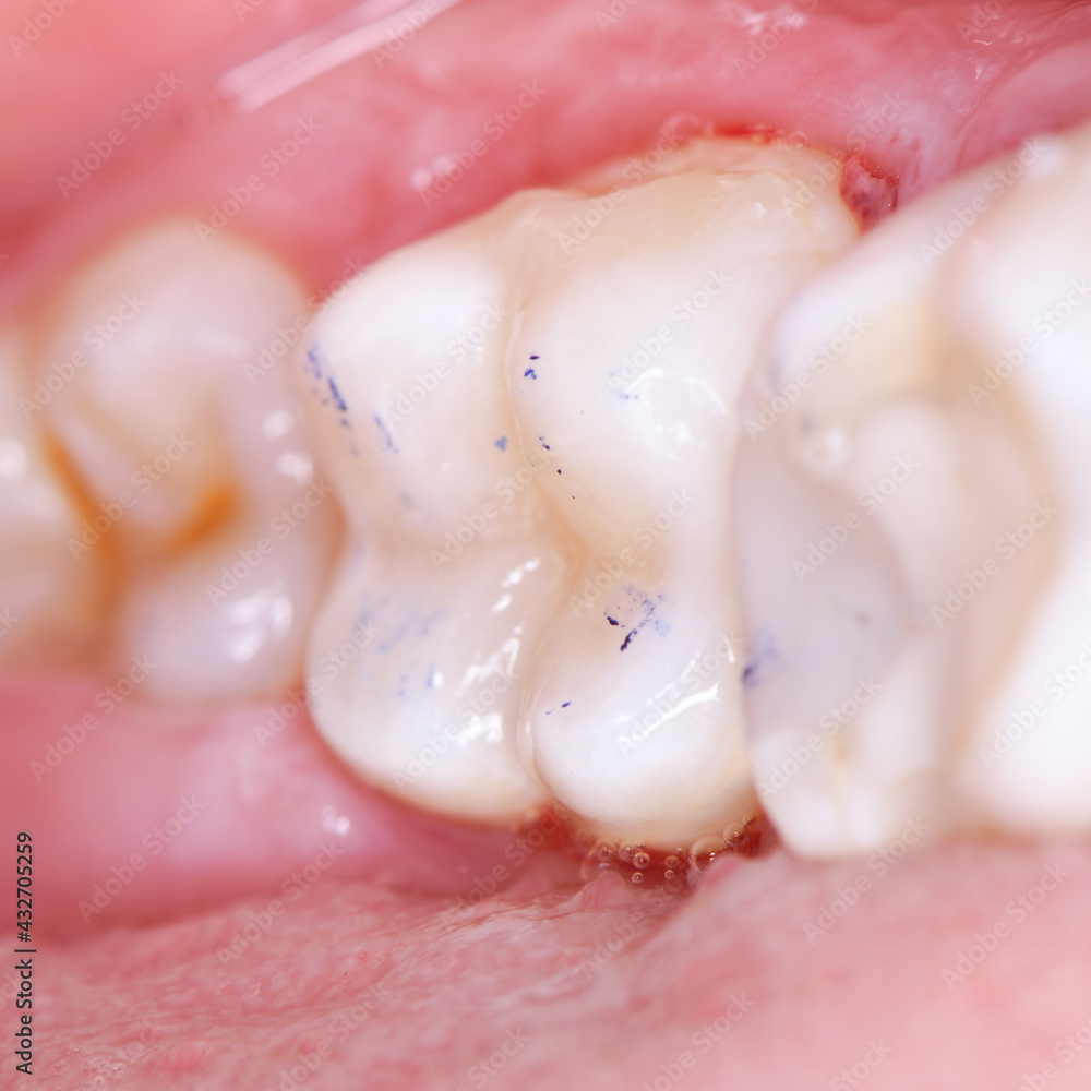 Fototapeta premium tooth cavity treatment with light cure composite