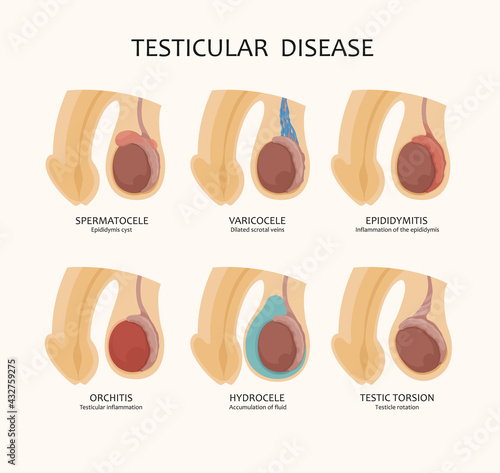 Various testicular diseases - such as varicocele, orchitis and others