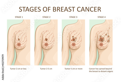Stages of breast cancer. Medical illustration photo