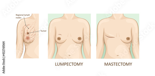 Mammary cancer. lumpectomy vs mastectomy