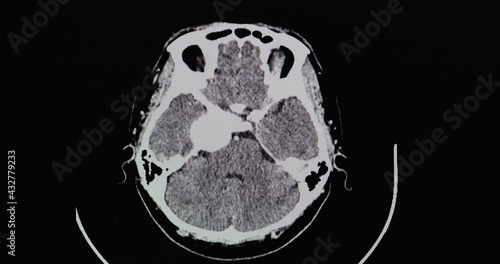CT brain scan with contrast of a patient showing 3.8 cm rim enhancing lesion at right cavernous sinus with internal calcification most likely menigioma or extra axial tumor. Right temporal craniotomy.