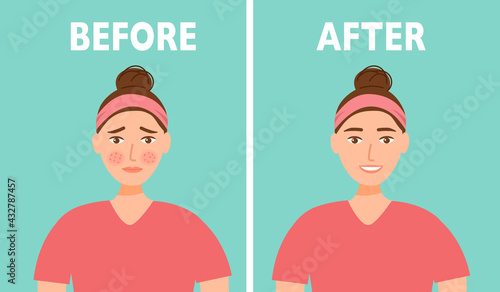 Woman face acne before and after skin care treatment in flat design.