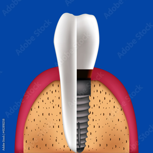 illustration of a spoon and fork. human teeth. Medical image in bright pink and beige colors on a dark violet background useful for poster, flyer or brochure graphic design.