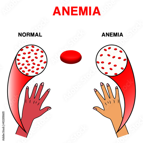 Infographic image of anemia. The difference between the number of red blood cells and the normal number of anemia. Realistic vector image of red blood cells or hemoglobin amount in human blood.Medical