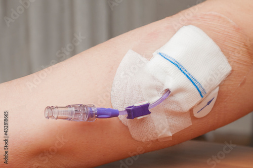 Konstfotografi Picc (Peripherally Inserted Central Catheter) in the arm of a young woman