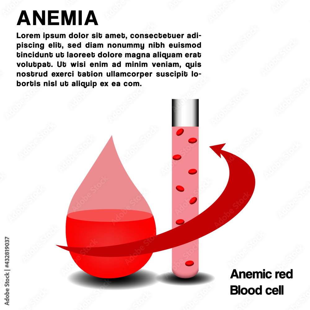 Infographic image of anemia. The difference between the number of red