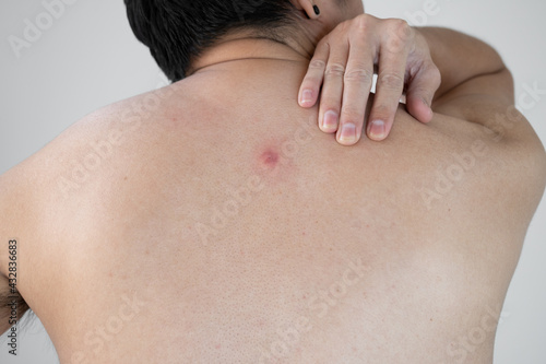 The back of a young Asian man with red abscesses or pimples.