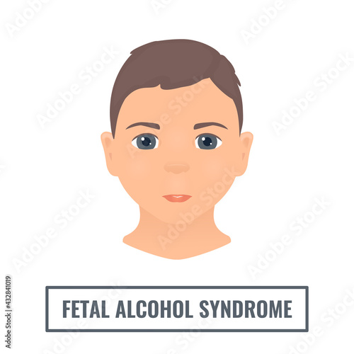 Facial features in a child with fetal alcohol syndrome. Foetal alcohol spectrum disorder signs. FASDs symptoms diagram. Medical concept. Vector illustration.