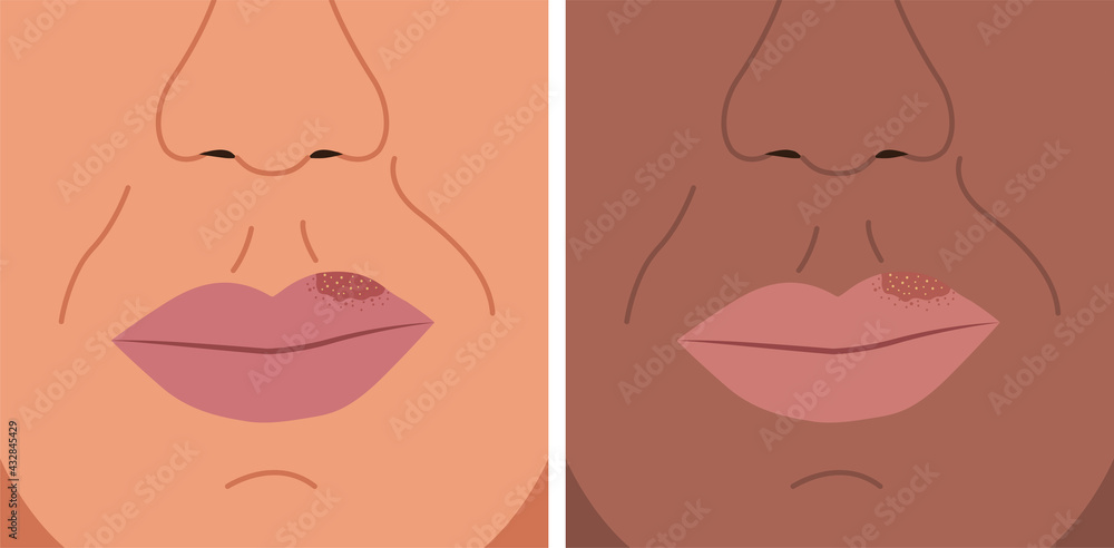 Vector illustration of herpes on the lip, cold sore, herpes simplex. Vector illustration of herpes on the lip, cold sore, herpes simplex.