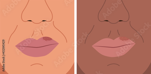 Vector illustration of herpes on the lip, cold sore, herpes simplex.