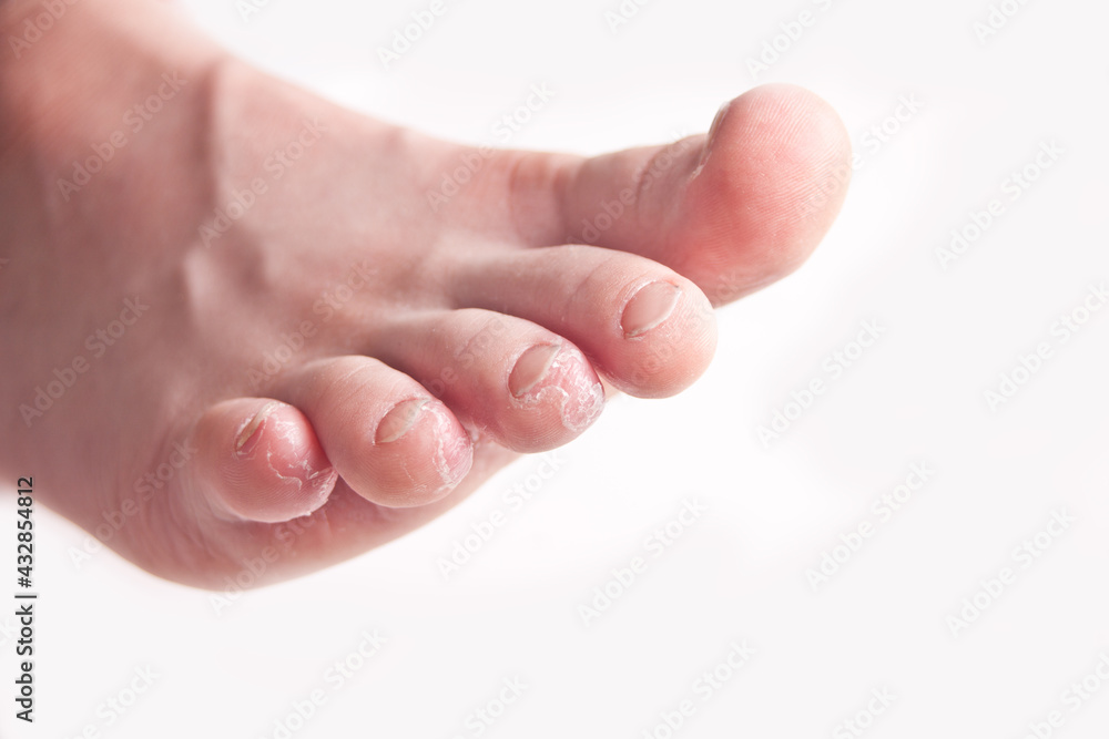 Kid feet with peel of dry skin. Closeup. Kid feet with peel of dry skin. Closeup.
