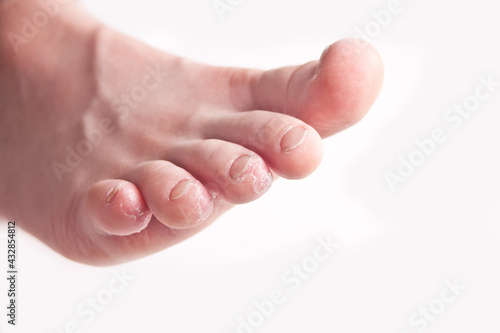 Kid feet with peel of dry skin. Closeup. photo