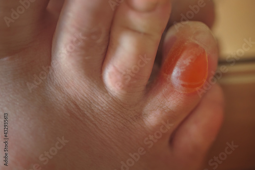 Friction blister - small pocket of body fluid within the upper layers of the skin, usually caused by forceful rubbing.