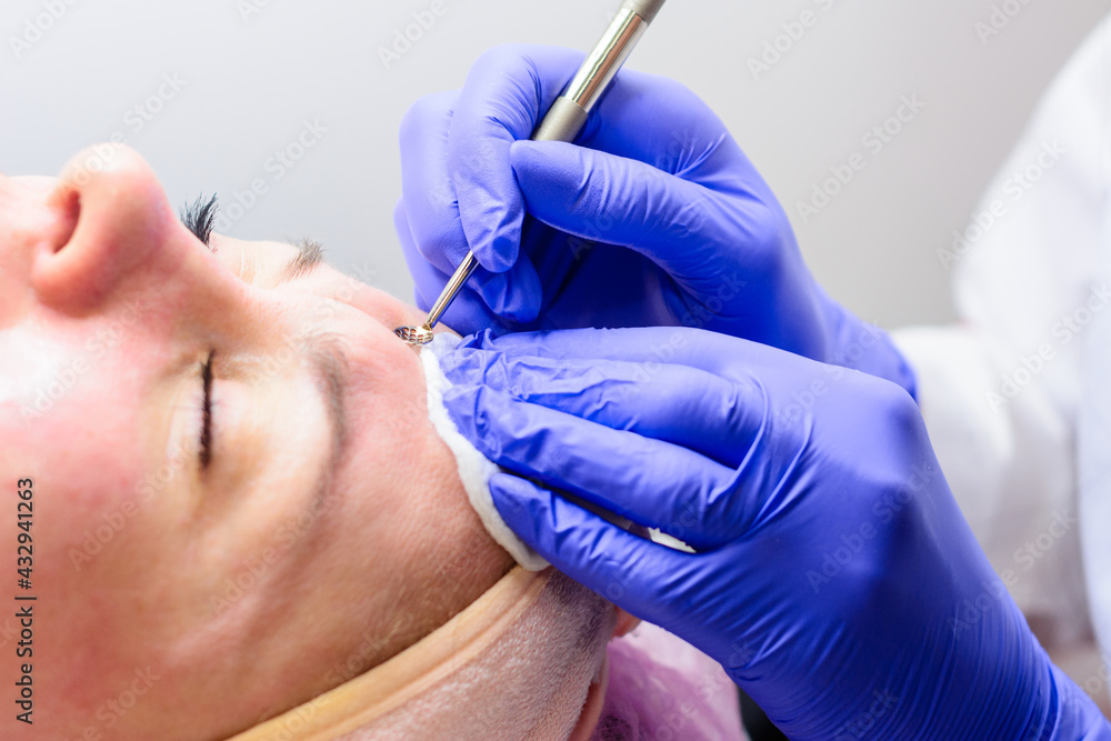 Mechanical facial cleansing, skin cleansing procedure from surface and