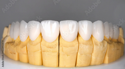 Beautiful upper teeth ceramic press veneers bleach of zircon arch prothesis Implants crowns. Dental restoration treatment clinic patient. Result of oral surgery procedure whitening dentistry