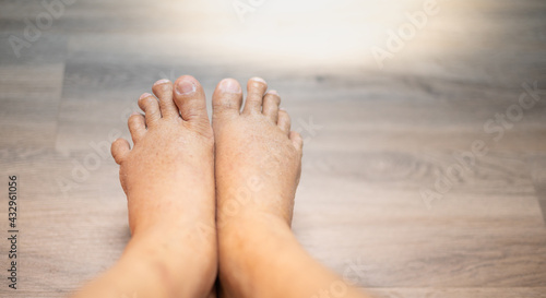The feet of old man wrinkle skin swollen feet with the cancer and the body lack of the protein for health so not good.