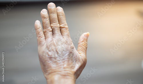 The hand of old man with the wrinkled hand and bruised from the body lack of nutrition protein.