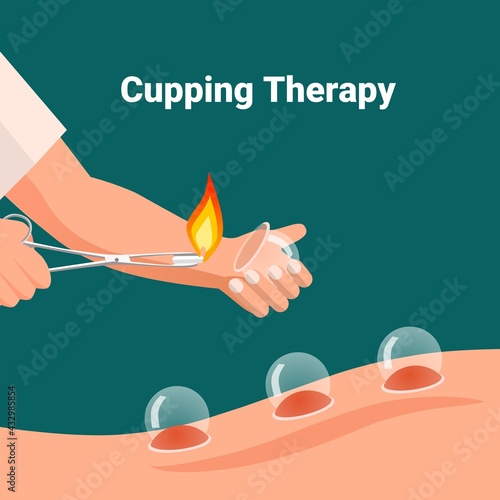 A therapist puts a cup of cupping with fire on the patient's back. Cupping or (Bekam Hijama) is an alternative treatment with cupping in which local suction is applied to the skin.