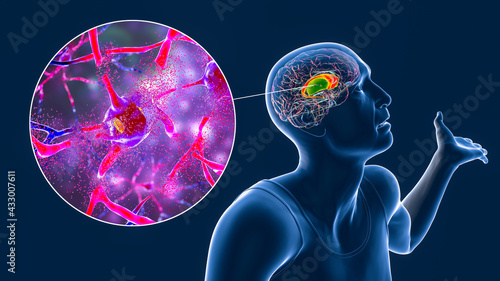 Canvas Print Dorsal striatum highlighted in the brain of a person with chorea disease and clo